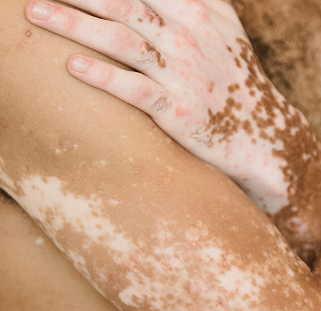 Skin Conditions & Rashes