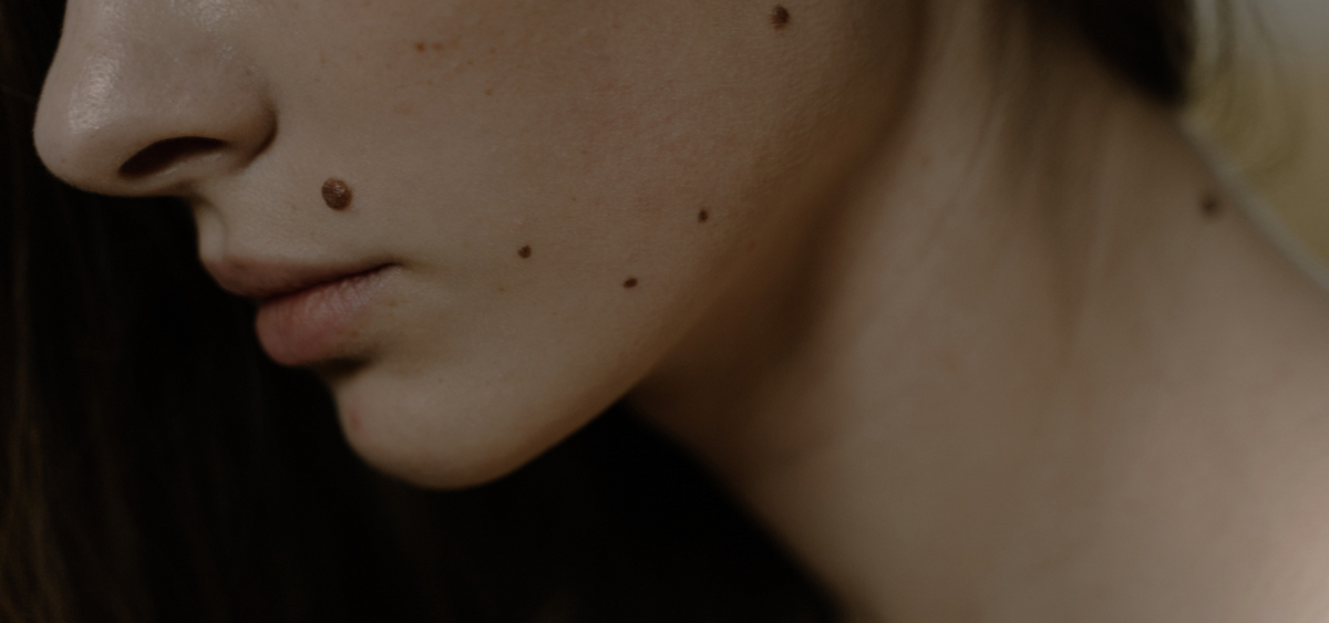 Skin exams & skin cancer screening