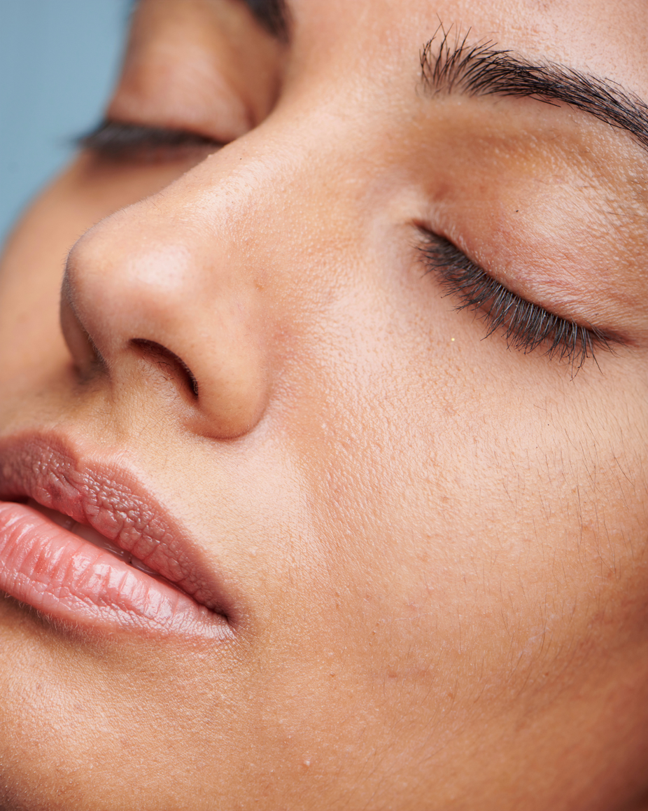 Acne Scars