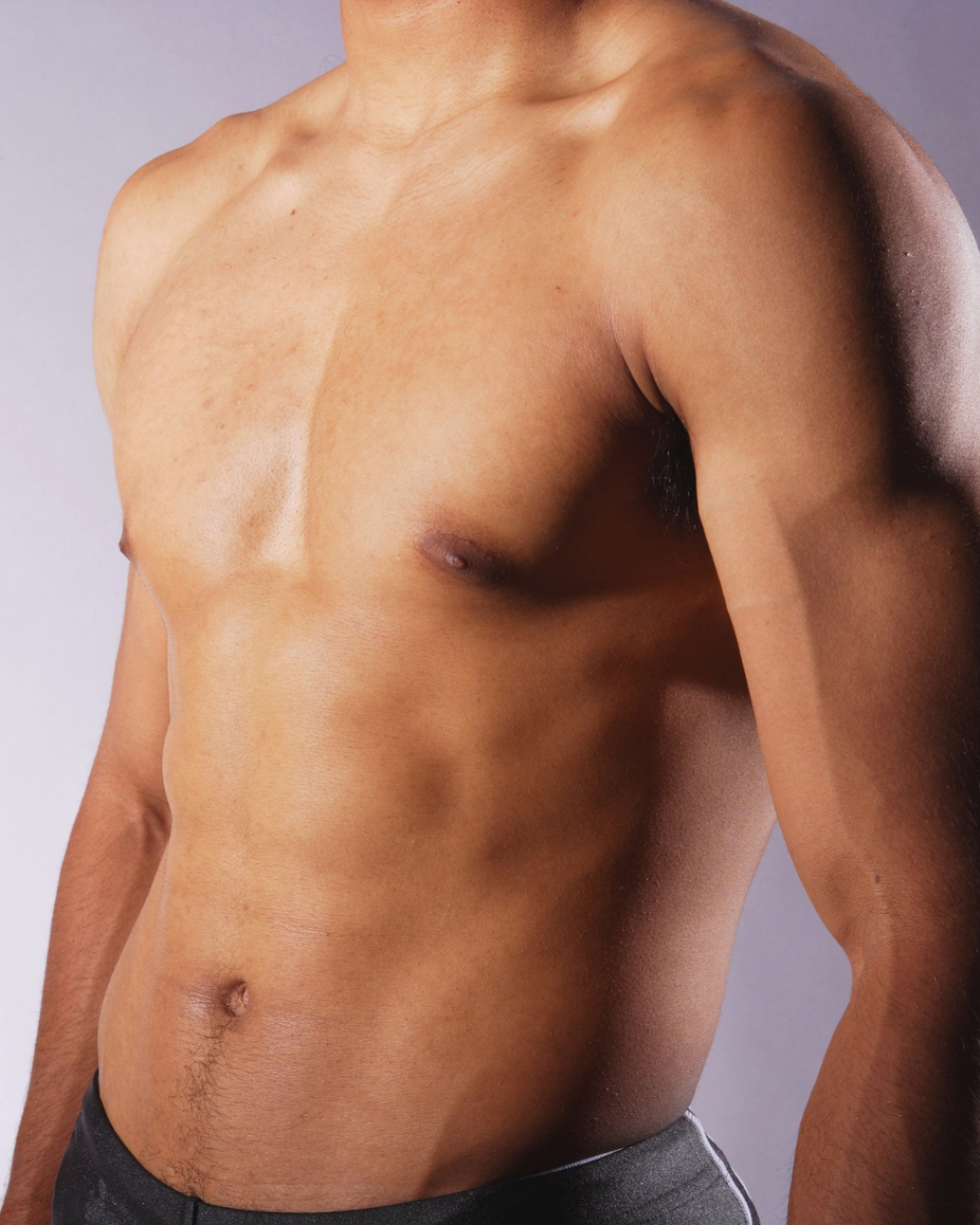 Laser Hair Removal